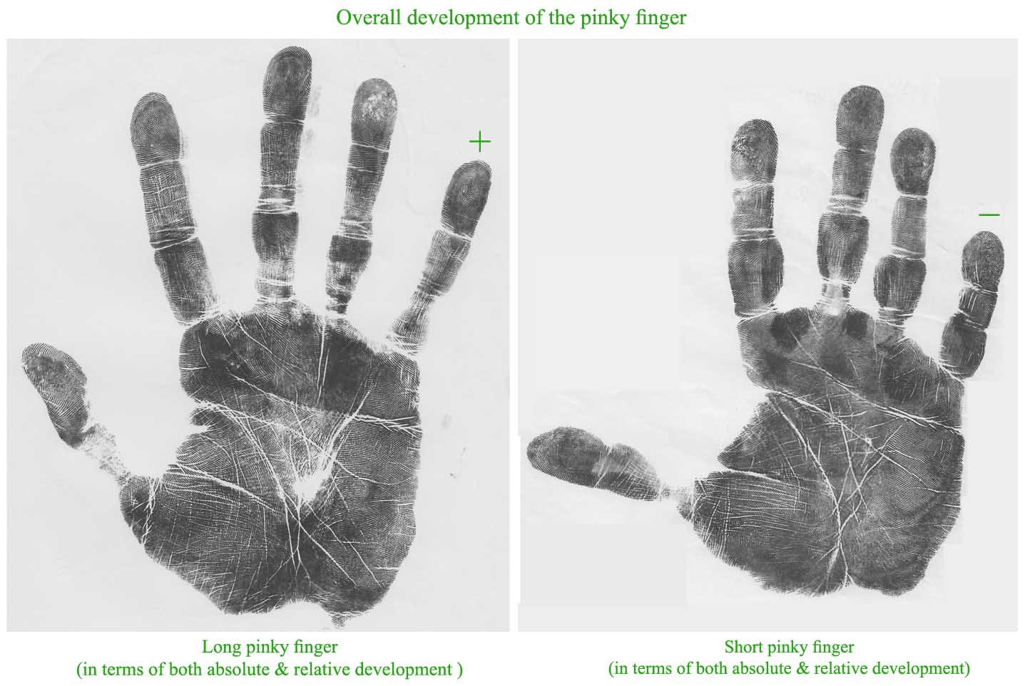Overall development of the pinky finger: long versus short.