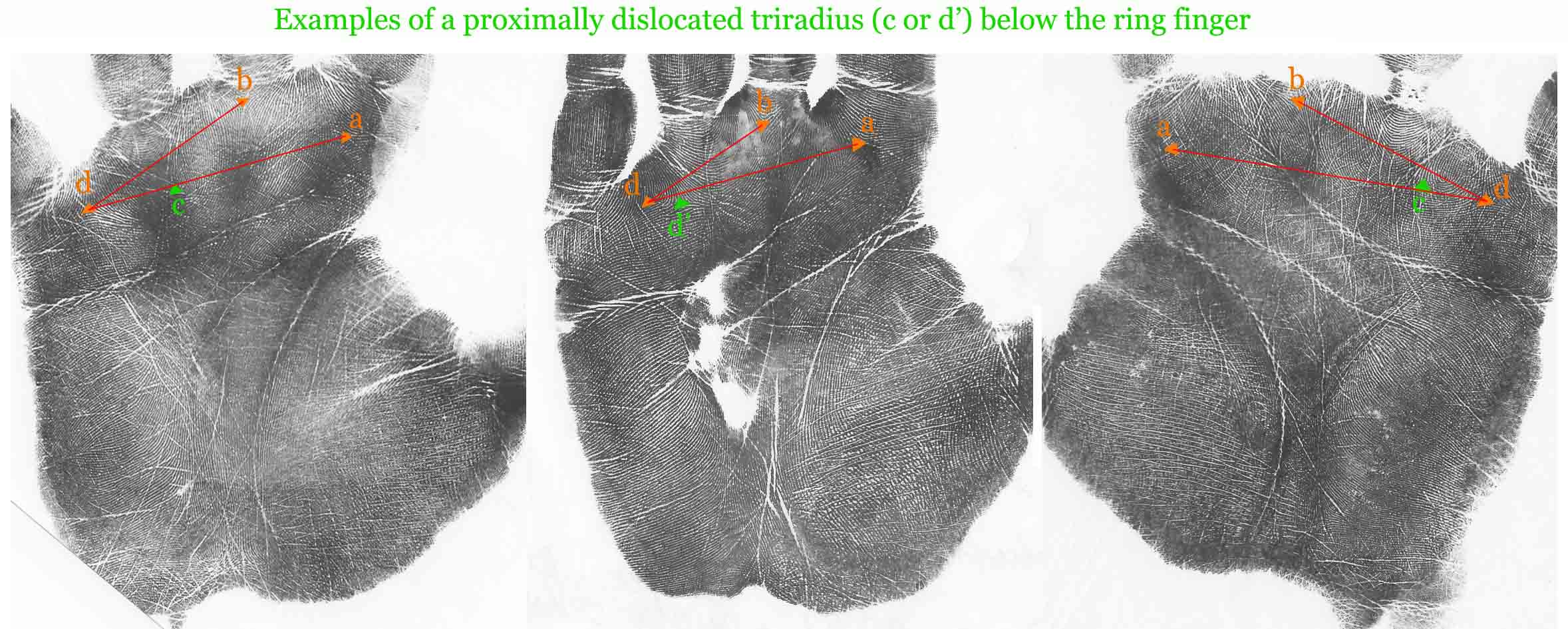 Examples of a proximally dislocated triradius below the ring finger.