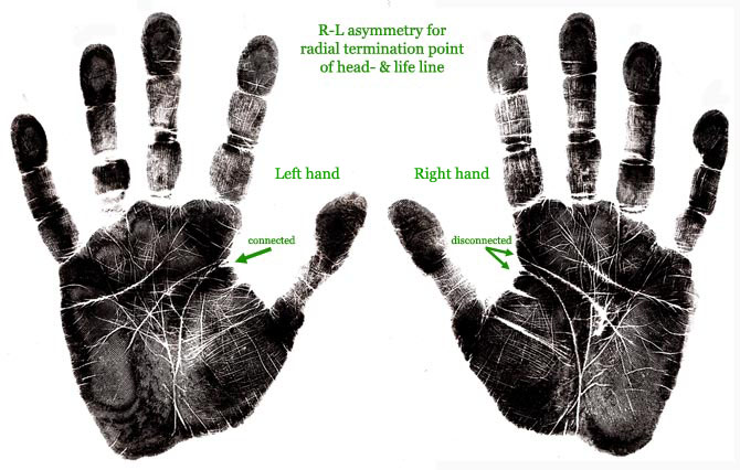 R-L asymmetry for the radial termination point of the head- & life line.