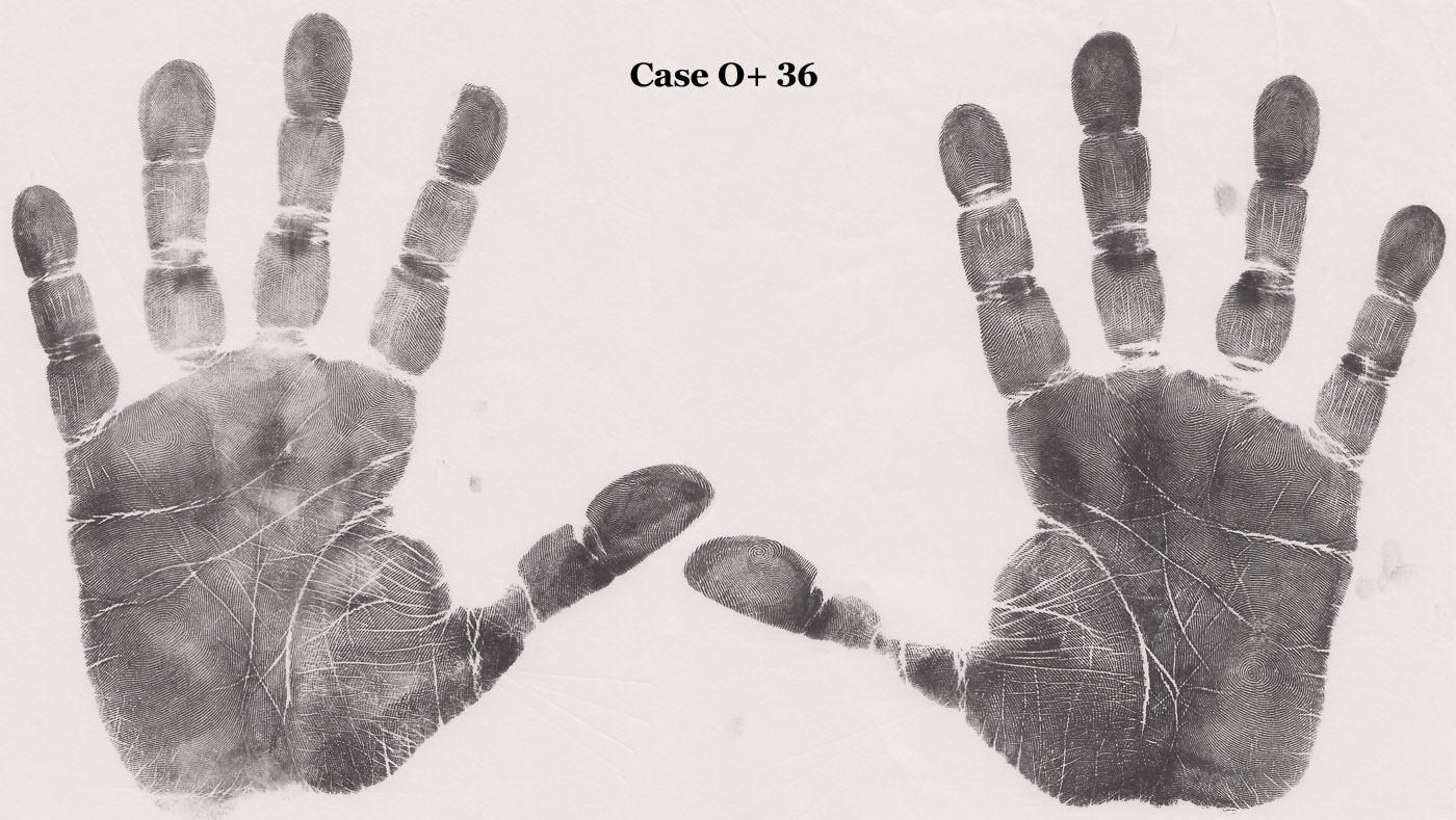 Openness high scorer (O+) with: dissociated proximal crease larger distance in left hand, in both hands dissociated proximal crease & displaced axial triradius, and in both hands dissociated proximal crease & high positioned axial triradius.