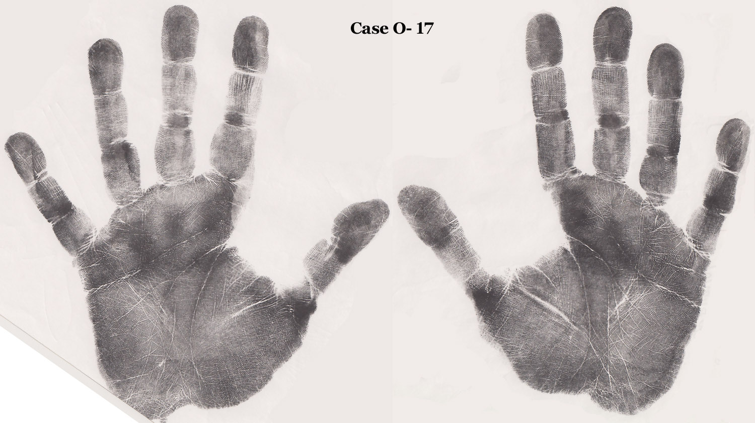 Openness low scorer (O-) with: connected proximal crease ends below axial triradius, disconnected proximal crease in right hand.