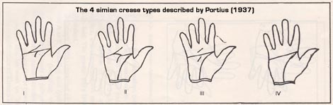 Portius (1937) described 4 simian crease types.