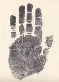 Schizophrenia & the hand: case 1.