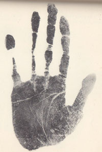 Schizophrenia & the hand: case 2.