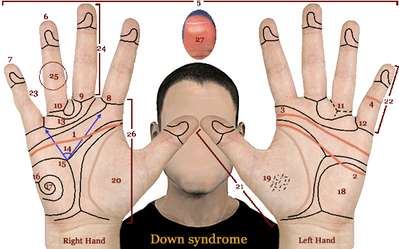 Phantom picture of the hand in Down syndrome, including a simian crease & Sydney crease.