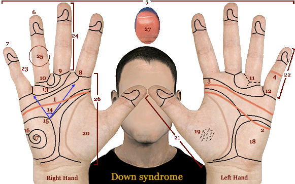 Hand chart for Down syndrome (2013).