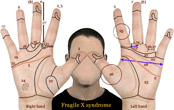 Phantom picture for Fragile-X syndrome: including the simian line.