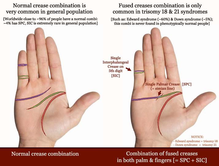 Fused creases in palm- & fingers: simian crease + single interdigital crease.