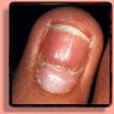 Fingernail disorder: Beau line.