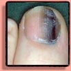 Black Toe Fingernails & Toenails