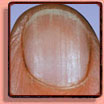 Nagelafwijking: broze nagels [brittle nails].