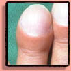 Fingernail disorder: clubbing.