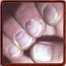 Diffuse reddish nail bed (lunula)