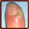 Paronychia according the Nail Tutor (edema nail fold)