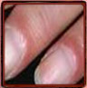 Paronychia according the Nail Tutor (erythema proximal fold)