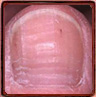 Horizontal ridges in the nail plate