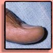 Koilonychia = spoon-shaped nails.