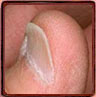 Koilonychia nails