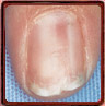 Red macule in nail bed