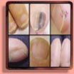 Nail disorders