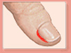 The lateral nail fold.