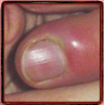 Paronychia according the Nail Tutor (nail fold swelling)