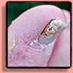 Fungus Fingernails & Toenails