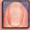 Pitting Fingernails & Toenails