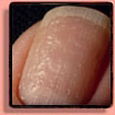 Fingernail pits: nail pitting.