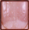 Nail Pitting according the Nail Tutor.