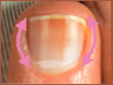 lateral nail fold #11