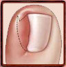 lateral nail fold #10