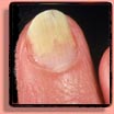 Onycholysis Fingernails & Toenails