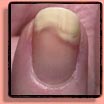 Fingernail disorder: onycholysis.