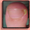Nagelafwijking: nagelriemontsteking [paronychia].