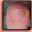 Paronychia Fingernails & Toenails