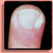 Paronychia Fingernails & Toenails
