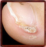 Fingernail Wart