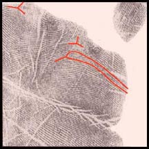 The hand in autistic spectrum disorder: unusual dermatoglyphics.