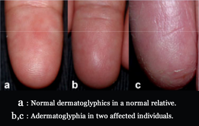 Adermatoglyphia: no fingeprints due to a genetic defect.