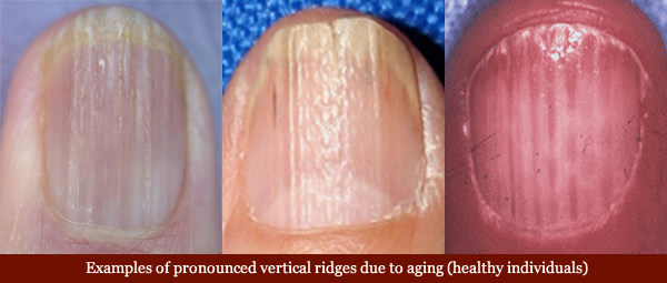 Examples of vertical fingernail due to aging.