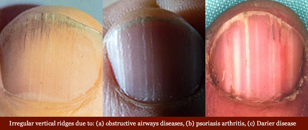 Examples of vertical fingernail ridges in diseases: obstructive airways, psoriasis arthritis, and Darier disease.