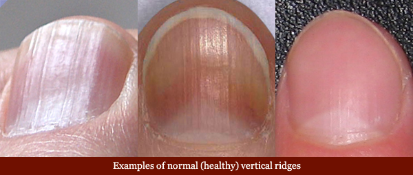 Examples of normal vertical fingernail ridges