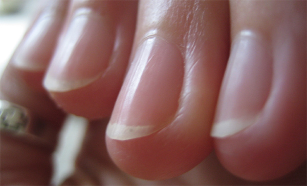 Vertical ridges in fingernails. Video: Dr Randy Martin answers the question