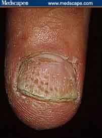 Alopecia areata nail pitting