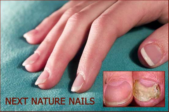 Onychomycosis due to artificial nails.