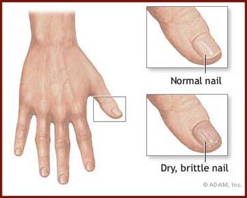 Brittle nails: what causes a dry brittle nail?