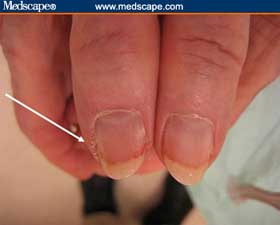 Chronic paronychia inflamation nail