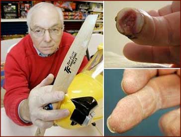 The man who grew a Finger!