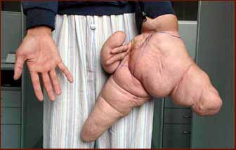 Macrodactyly patient Liu Hua used to have the largest hand in the world ever.